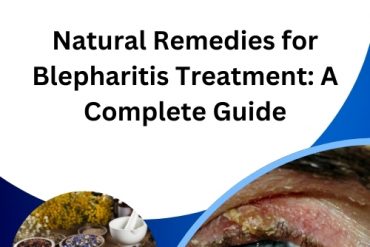 Natural Remedies for Blepharitis Treatment A Complete Guide