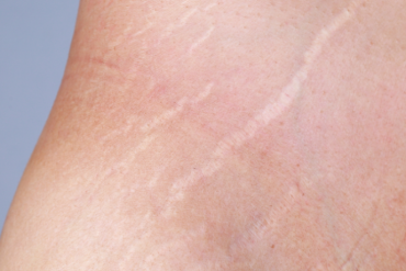 What to Expect from Laser Treatment for Stretch Marks