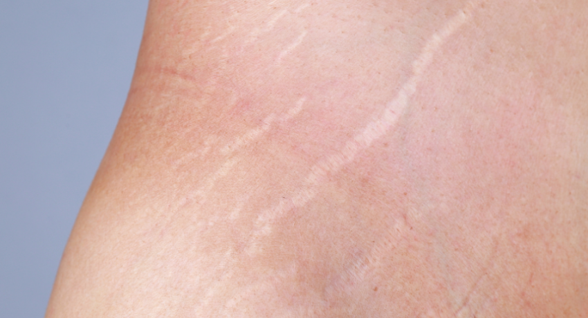 What to Expect from Laser Treatment for Stretch Marks