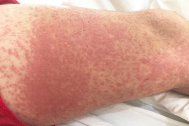 symptoms of kidney-related rashes