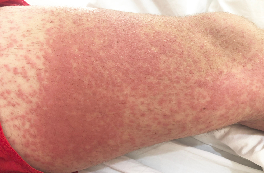 symptoms of kidney-related rashes