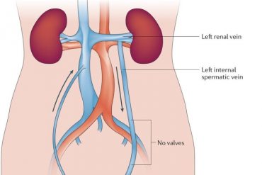 varicocele embolisation