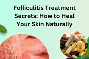 Folliculitis Treatment Secrets