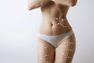 Is Liposuction Permanent What You Need to Know About Long-Term Results