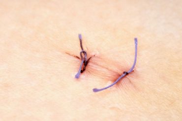 Can You Remove Your Child’s Stitches at Home
