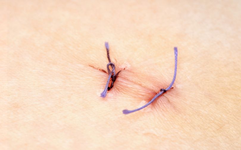 Can You Remove Your Child’s Stitches at Home