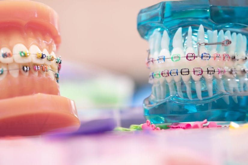 Do Dental Braces Change Your Face Shape Aesthetic Insights