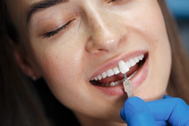 Eating with E-max Veneers What’s Safe & What to Avoid
