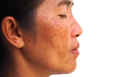 Melasma Treatments for Sensitive Skin What to Try