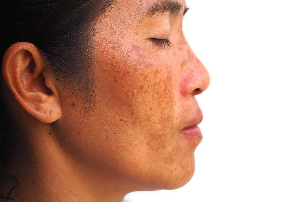 Melasma Treatments for Sensitive Skin What to Try