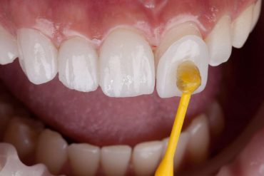 Non-Prep Veneers and Tooth Health Separating Fact from Fiction