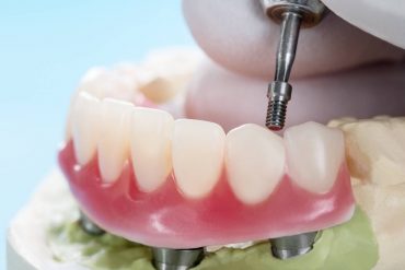 Teeth Dentures