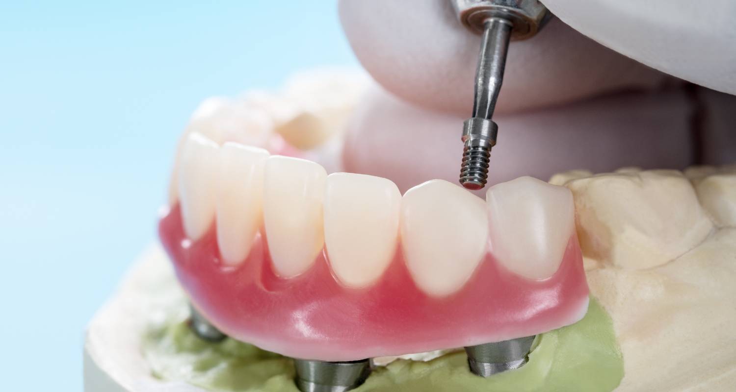 Teeth Dentures