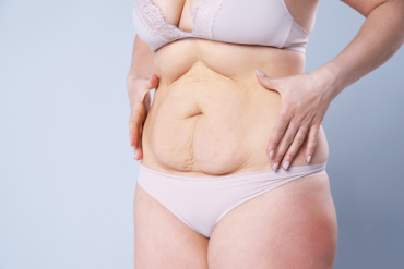 Understanding the Different Types of Tummy Tuck Procedure