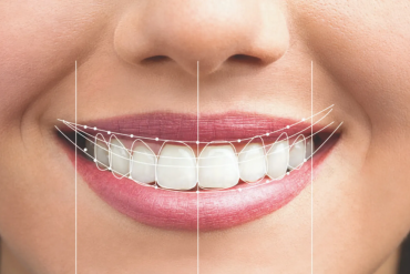 What Makes Digital Smile Design Different from Traditional Smile Makeovers