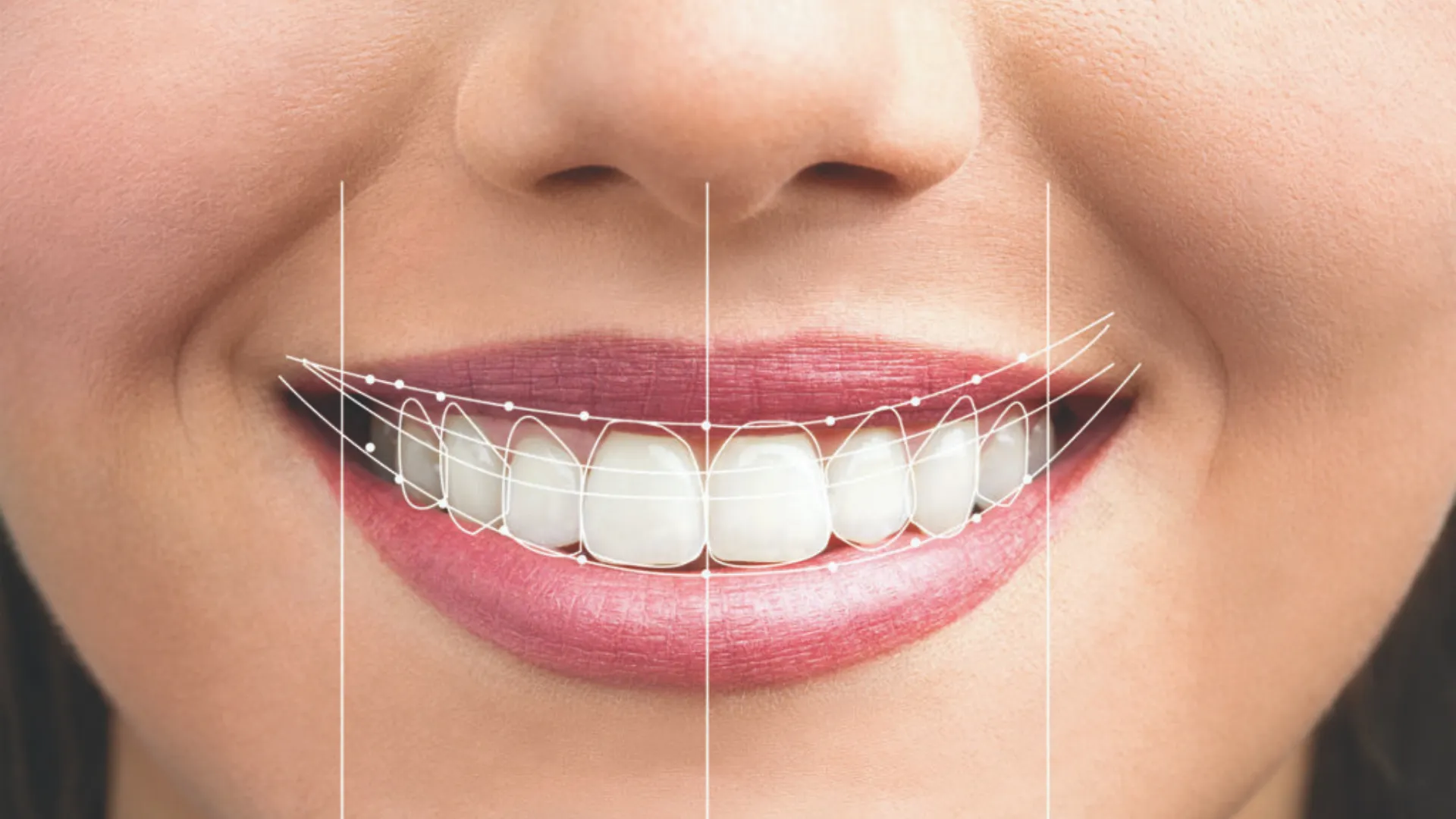 What Makes Digital Smile Design Different from Traditional Smile Makeovers