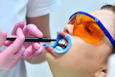 Will Zoom Teeth Whitening Work on Veneers or Crowns