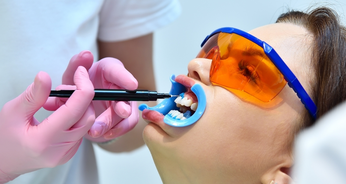 Will Zoom Teeth Whitening Work on Veneers or Crowns