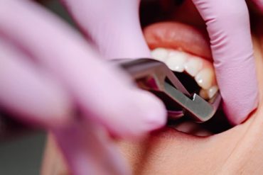 Wisdom Tooth Removal with Minimal Swelling Is It Possible