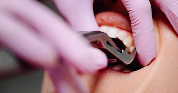 Wisdom Tooth Removal with Minimal Swelling Is It Possible